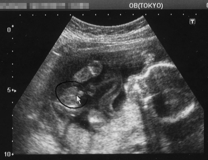 続 こんにちは 赤ちゃん 性別判明 エコー写真による妊娠初期の成長記録